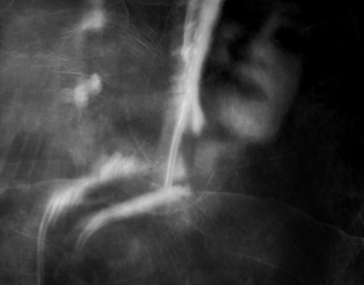Surrealistic Portrait Photograph By Philippe Berthier, 25 X 20", Surdosage De Silicone..., Original Artwork